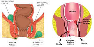 abscess and fistula gutcare
