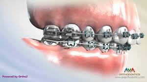 And though the overbite correction period varies from patient to patient, correcting severe overbite cases through braces takes a minimum of 2 years. Orthodontics Treatment For Overjet Overbite Headgear Vs Forsus Appliance Youtube