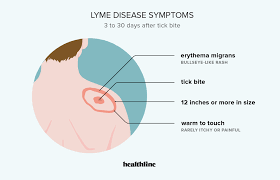lyme disease symptoms signs