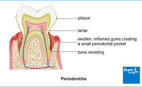 Gum Disease Infection Periodontitis Bupa Dental Care Uk