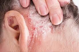 scaly or flaky skin causes symptoms