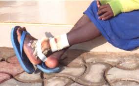 Image result for crianças angolanas mutiladas