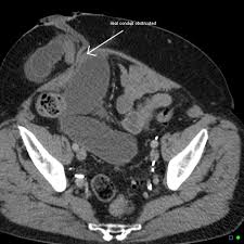 Your doctor will use a small piece of your intestine called the ileum to create the ileal conduit. Incarcerated Parastomal Hernia Causing Small Bowel And Ileal Conduit Obstruction Radiology Case Radiopaedia Org