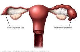 Pelvic inflammatory disease (pid) is an std, which causes pelvic inflammatory disease causes painful inflammation of the female reproductive organs, including the cervix, uterus and other structures. Pelvic Inflammatory Disease Pid Symptoms And Causes Mayo Clinic