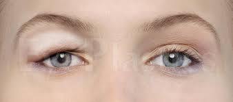fix droopy puffy or tired eyes