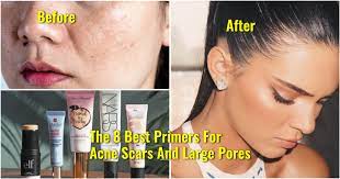 large pores and acne scars