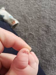 weird baby toenails babycenter