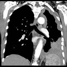 A plethora of markers have been used in the diagnosis of mesothelioma, but mainly to rule it out. Mesothelioma Radiology Reference Article Radiopaedia Org
