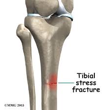 tibia stress fracture specialist