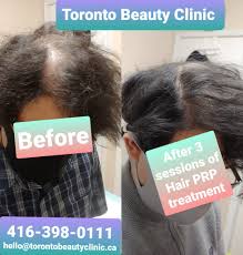 toronto hair loss treatment with prp