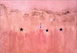 nail fold capillaroscopy for the