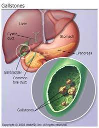 gallstones picture symptoms types