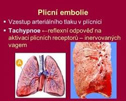 Plicní embolie často vzniká náhle a mnohdy ji nebývá snadné odhalit. Srdecni Embolie Seznam Cz