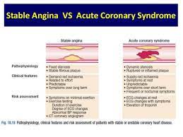 Unstable angina is just like its name says: Stable Angina