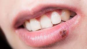 cold sores symptoms causes treatment