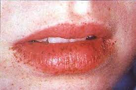lip freckle