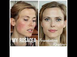 my rosacea foundation routine makeup