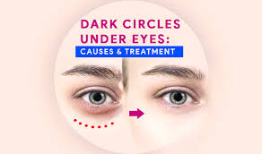 dark circles under eyes causes