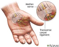 carpal tunnel syndrome medlineplus