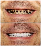 why-are-veneers-cheaper-in-turkey