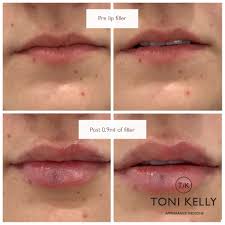 dermal fillers lip fillers cheek