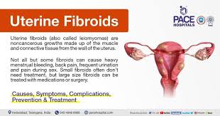 uterine fibroids symptoms causes