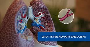 A pulmonary embolism (pe) is a blood clot in the lung. What Is Pulmonary Embolism Causes Symptoms And Diagnosing