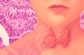 why are thyroid disorders on the rise