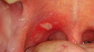 p on the roof of the mouth 12 causes
