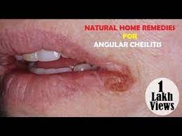 mouth corner s angular cheilitis