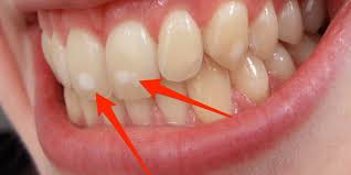 protect your smile from white spots