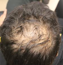 You may notice sudden hair loss or a gradual thinning over time. Dr Donovan S Hair Loss Articles 2011 2021 Donovan Hair Clinic