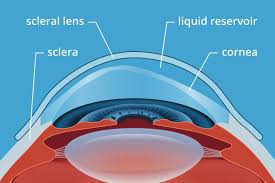 scleral lenses what s the big deal