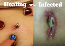 infected belly on piercing