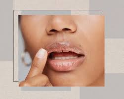 essential oils for chapped lips