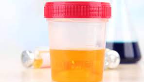 dark orange amber or brown urine could