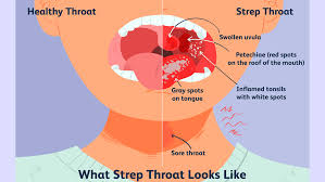 treatment for strep throat in