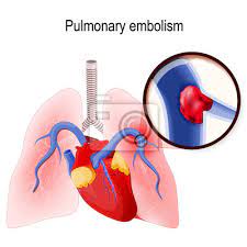Plicní embolie je velmi závažný stav, při kterém je úmrtnost vyšší než při infarktu myokardu.nebezpečí plicní embolie je v tom, že přichází bez varování a velmi náhle.u pacientů, kteří ji přežijí jsou časté komplikace. Plicni Embolie Fototapeta Fototapety Trombus Chuchvalec Medicals Myloview Cz