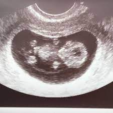 Wünsche euch allen eine tolle schwangerschaft! á… 10 Ssw Schwangerschaftswoche Alle Infos Grosse Entwicklung