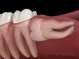 wisdom tooth infection causes