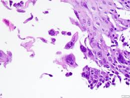 pathology outlines herpes simplex virus
