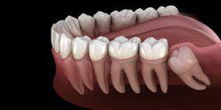 ct dental implant