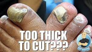t extremely thick toenails
