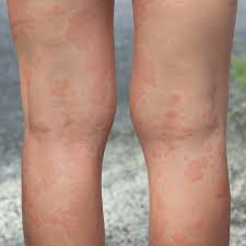 what causes a rash that moves to