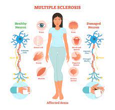 understanding multiple sclerosis