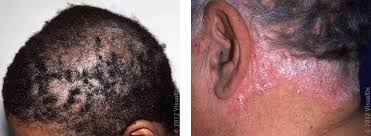 what is scalp eczema treatment causes