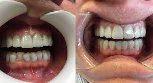 Plus, dental bonding is sometimes covered by insurance. Porcelain Veneers Vs Dental Bonding Know The Pros And Cons Cns Dental