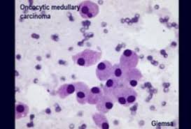 To compare the advantage of preoperative fnac of thyroid swellings with postoperative histopathology to reach a consensus protocol as a simple procedure for. Thyroid Nodule Can Molecular Tests Improve Fine Needle Aspiration Cytology Diagnostic Assessment Aspic