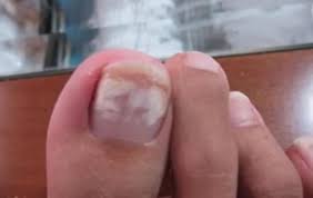 white toenail fungus its symptoms and