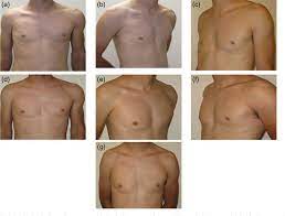 Poland syndrome is a condition where a child is born with missing or underdeveloped chest muscles. Pdf Successful Use Of Adipose Derived Mesenchymal Stem Cells To Correct A Male Breast Affected By Poland Syndrome A Case Report Semantic Scholar